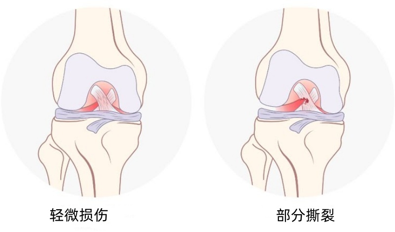 华体会登入-季后赛带伤作战！杰威接受右手韧带撕裂修复手术